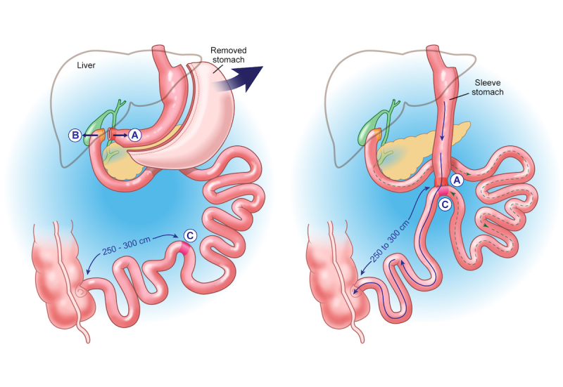 Duodenal Switch surgery diagram