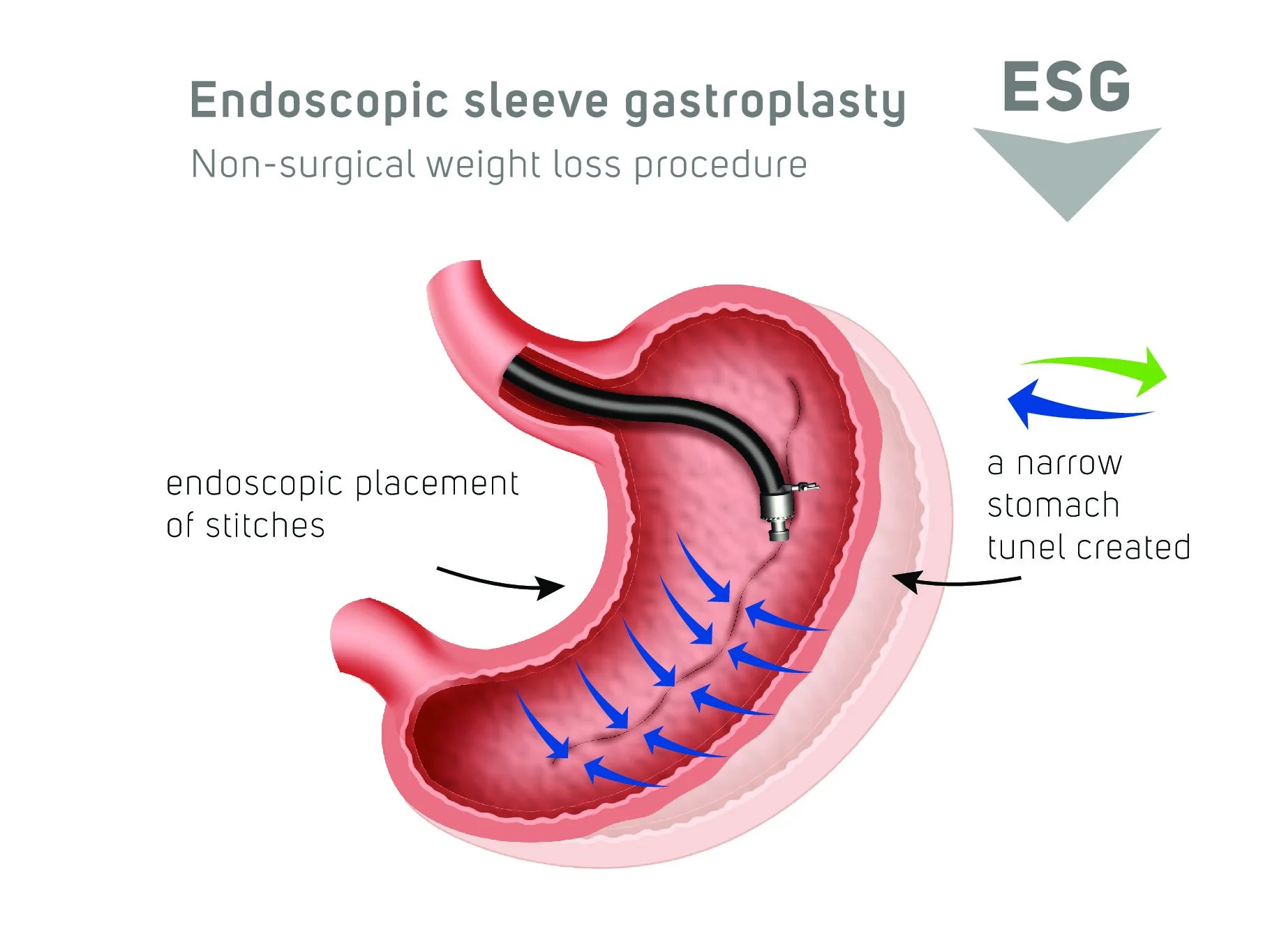 Endoscopic Sleeve Gastroplasty diagram