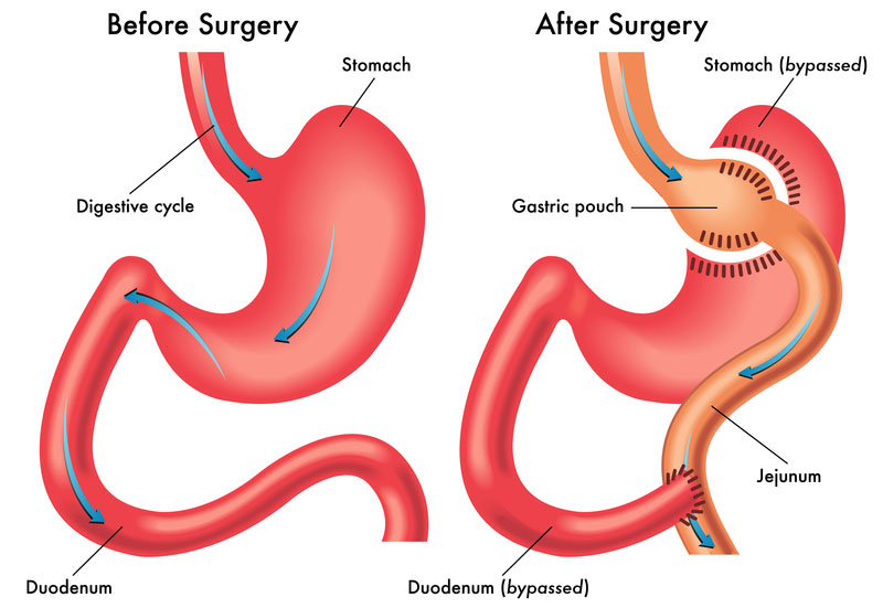 Gastric Bypass surgery diagram