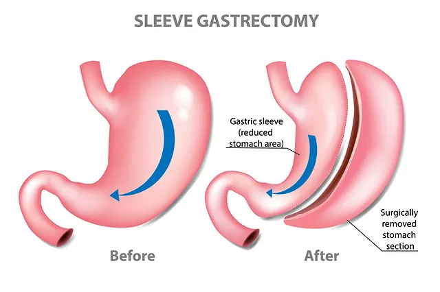 Gastric sleeve surgery at Lighter Dream Tijuana