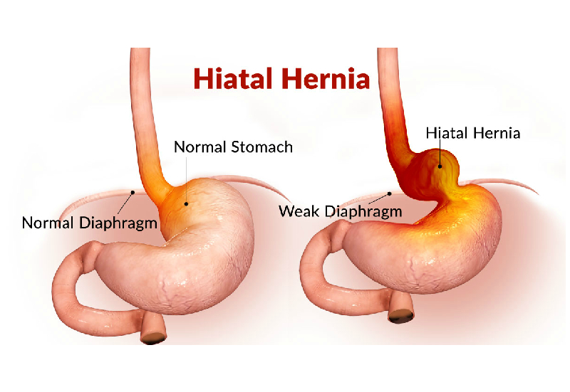 Hiatal Hernia Repair diagram