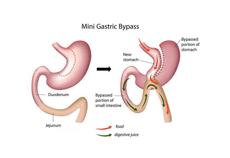 Mini Gastric Bypass surgery diagram