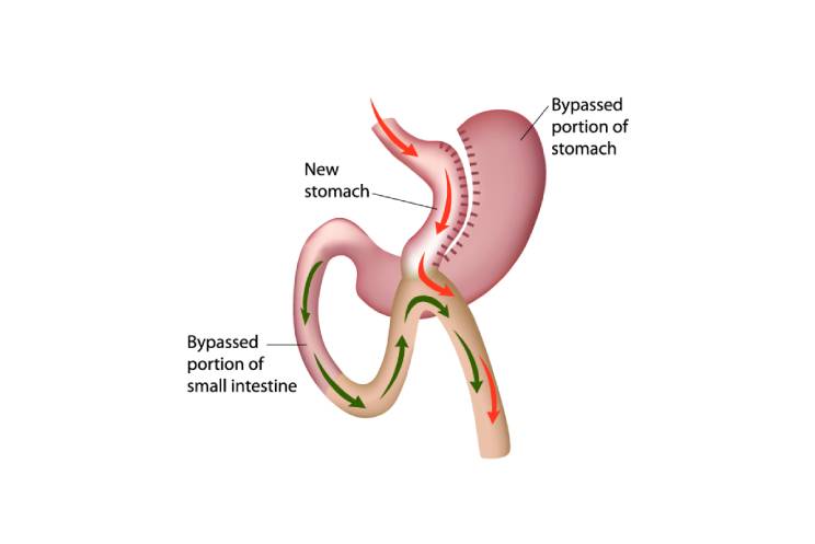 how-to-prepare-for-your-gastric-bypass-surgery-1