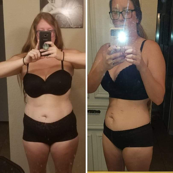Arm lift brachioplasty results
