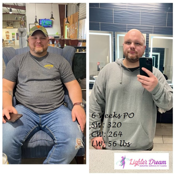 Body lift contouring results