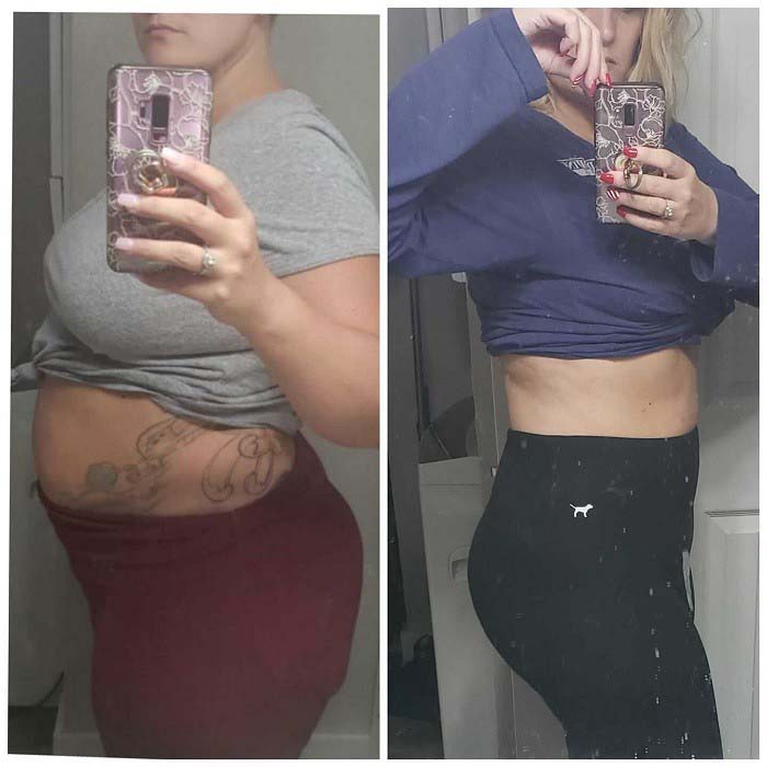 Mommy makeover patient transformation