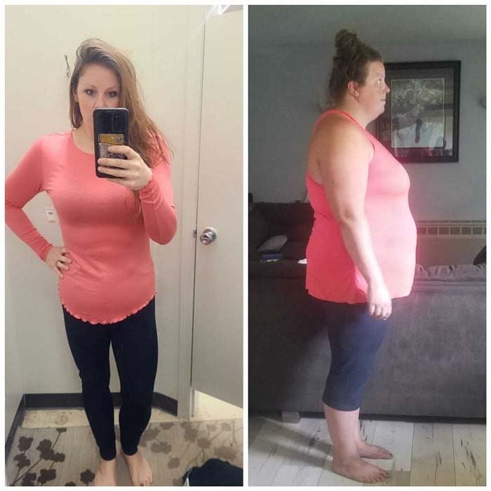 Tummy tuck body contouring results
